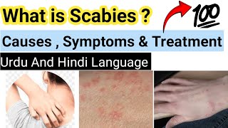 What is scabies CausesSymptoms amp Treatment  👉 In Urdu [upl. by Aniv]