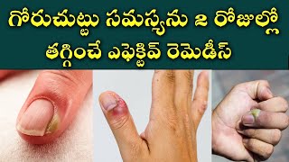 Effective Home Remedies for Nail Fungus  How to Prevent and Treat a Paronychia  Goru Chuttu [upl. by Rhys]