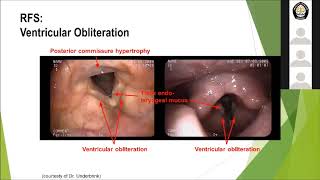 Laryngopharyngeal Reflux LPR [upl. by Questa155]