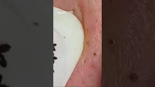 Pickel Ausdrücken Spa  Blackheads Akne amp Mitesser entfernen 🔴 81 [upl. by Vannie519]