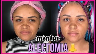 MINHA ALECTOMIA 👃 [upl. by Netsua]