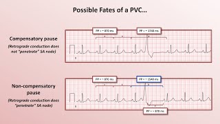 Advanced EKGs  PACs and PVCs ie premature beats [upl. by Waldon320]