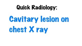 QUICK RADIOLOGY Cavitary lesions on chest X ray [upl. by Nairda]