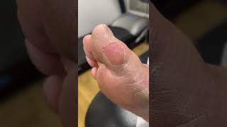 Big Toe Callus Removal by Australian Podiatrist  Effective Treatment for Calluses and Corns [upl. by Rogovy]