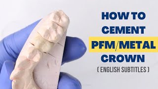 Dental Crown Procedure Start To Finish w Explanation C6 [upl. by Feldt930]