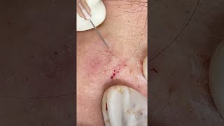 Big Cystic Acne Blackheads Extraction Blackheads amp Milia Whiteheads Removal Pimple Popping shorts [upl. by Noseaj]