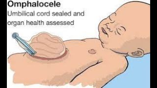 Embryological basis for Omphalocele  Exomphalos Cause of Omphalocele [upl. by Sonja246]