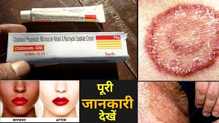 Clobenate Gm Cream Uses Or Side Effects in hindi [upl. by Axela]