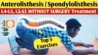 Lumbar Anterolisthesis l5 s1 treatment spondylolisthesis l4l5 exercises in hindi without surgery [upl. by Balkin]