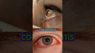 Tratamiento para la Conjuntivitis conjuntivitis tratamiento antibioticos bacteria ojos minsa [upl. by Ludlew48]