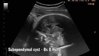 Case 38 Fetus 33w2d  subependymal pseudocyst  Nang dưới mầm [upl. by Ati]