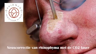 Neuscorrectie van rhinophyma met de CO2 laser [upl. by Havens513]