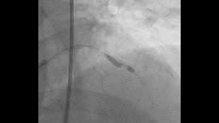 balloon undilatable coronary lesion role of rotatripsy [upl. by Aiceila]