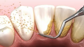 Dental scaling teeth animation [upl. by Doane]