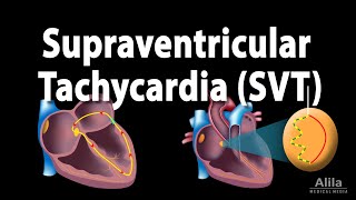 Supraventricular Tachycardia SVT PSVT Animation [upl. by Howlan610]