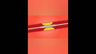 Angioplasty Artherosclerosis Treatment heart disease facts educationexam drawing [upl. by Eldrid]