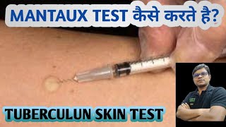 Mantoux test  TST  PPD  Tuberculin skin test  Diagnosis of TB [upl. by Wehrle]