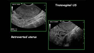 ultrasound of uterus [upl. by Nerb]