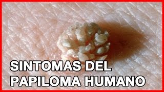 Sintomas del Papiloma Humano [upl. by Dorsey]