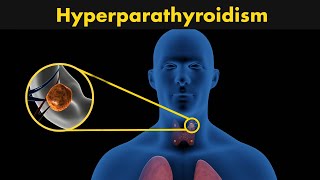 How hyperparathyroidism occurs  DiagnosisTreatment and symptoms of hyperparathyroidism [upl. by Guillermo]