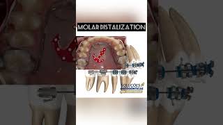 MINIMPLANT SUPPORTED MOLAR DISTALIZATION  ORTHODONTIC TIPS Shorts [upl. by Hutt]