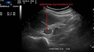 adenoma surrenalico sinistro [upl. by Aubrey]