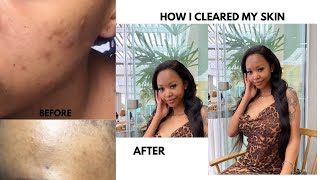 HOW I CLEARED MY ACNE USING ORATANE [upl. by Sulrac455]