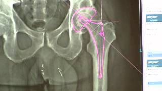 PreOperative Planning for a Total Hip Replacement [upl. by Auhoj]