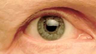 My Right Pupil Exhibiting Hippus  Pupillary Athetosis [upl. by Reagen]