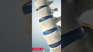 Spinal stenosis [upl. by Therese]