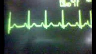 ECG Video Ectopics  Atrial [upl. by Beetner]