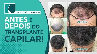 Resultado de Transplante Capilar Antes e depois [upl. by Nahpos585]