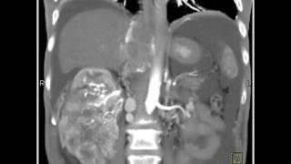 Abdomen Kidney Renal cell carcinoma invades the IVC and extends into the right atrium2 of 2 [upl. by Ariayek]