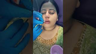 Nose amp Lip Filler Correction Treatments kolkatafashion skincare youtubeshorts youtubereels [upl. by Norat]