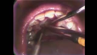 12a Maxillary Canine Impaction [upl. by Nilek]