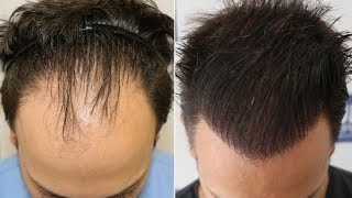 FUE Hair Transplant 4335 Grafts  NW Class IV  Vertex By Dr Juan Couto  FUEXPERT CLINIC [upl. by Range]