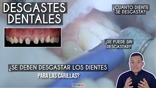 ¿Se deben desgastar los dientes para las carillas 🤔 ¿Se hace en todos los casos Odontología Láser [upl. by Ariela689]