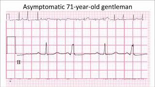 ECG in 60s  Case of quotquotVentricular Bigeminyquot [upl. by Clayborn]