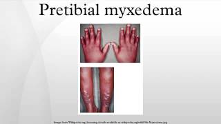 Pretibial myxedema [upl. by Nadler]