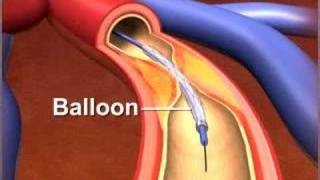 Percutaneous coronary Intervention stenting [upl. by Naul]