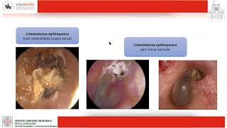 Gestione del colesteatoma  webinar giugno 2020 [upl. by Alled]