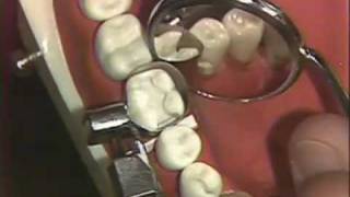 Packing of Class II Amalgam for Hygienists [upl. by Pass]