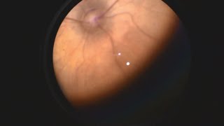 Retinopathy of Prematurity [upl. by Anirpas]