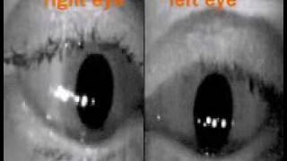 Eye Movevement Examples [upl. by Neltiac]