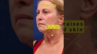 One Year Post FaceliftDeep Neck Lift Examining Poikiloderma [upl. by Ahsetal212]