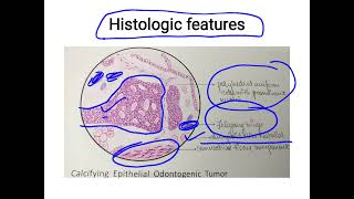 Adenomatoid odontogenic tumor HISTOPATHOLOGYradiographic featuresclinical featuresTreatment [upl. by Joice]