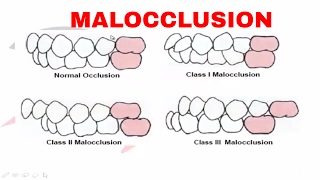 Malocclusion  Part I [upl. by Squier566]