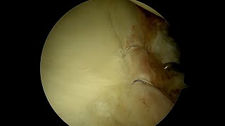 Probing the Labrum Assess Its Stability Following Arthroscopic Repair [upl. by Hguh419]