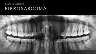 Fibrosarcoma [upl. by Champ]