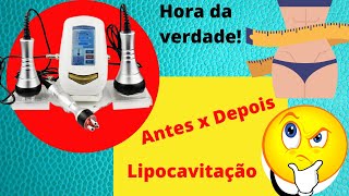 🔥Lipocavitação e Radiofrequência Antes X Depois🔥 [upl. by Annerb]